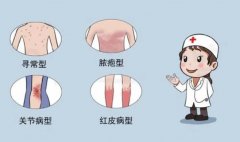 南京皮研所介绍：银屑病的症状是什么样子