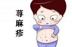 荨麻疹怎么好得快